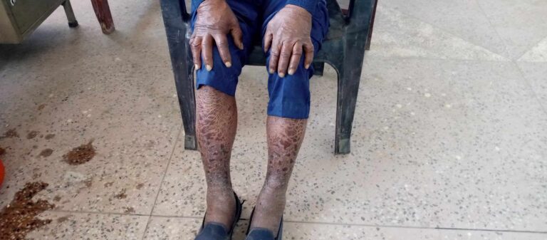 कुष्ठरोगको जोखिम कायमै, निवारणको कार्यक्रम शुन्य